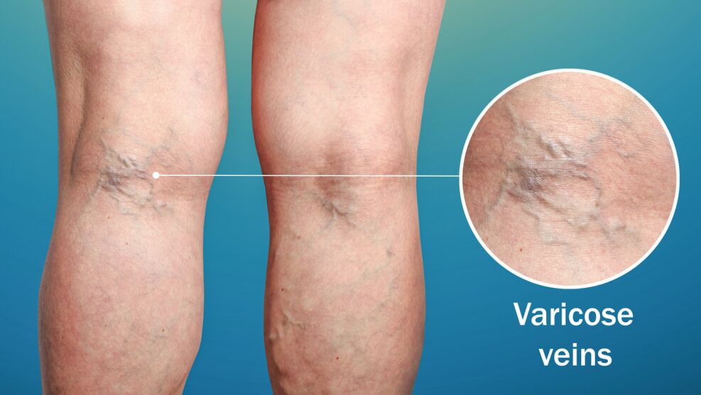 Varices nas pernas