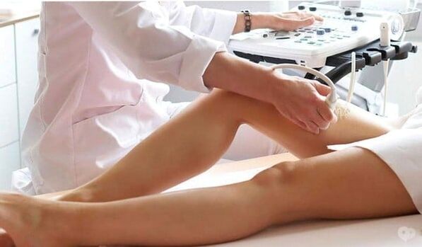 Tratamento de varices
