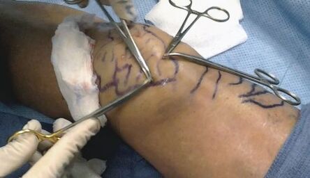 Cirurxía para varices