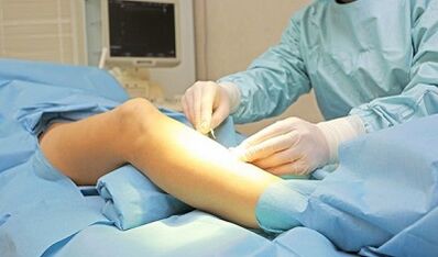 Métodos operativos para tratar as varices nas mulleres