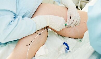 Métodos para o tratamento das varices nas pernas das mulleres