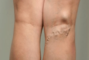 Diagnóstico de varices en mulleres embarazadas