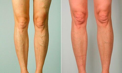 antes e despois do tratamento de varices