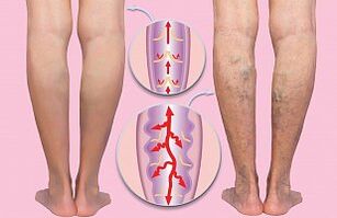 varices das extremidades inferiores
