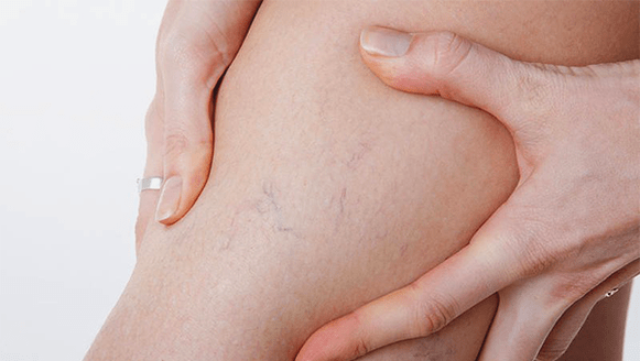 varices nas pernas