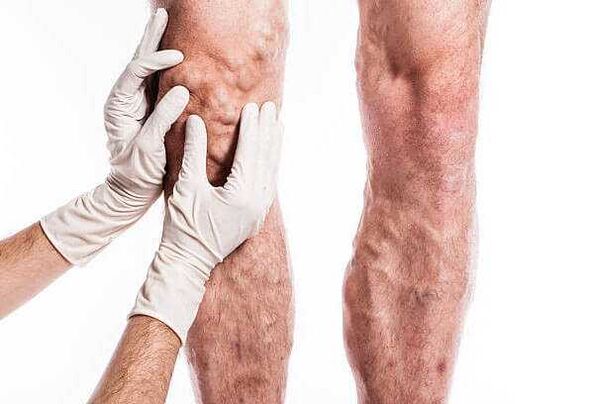 Palpación de varices nas pernas
