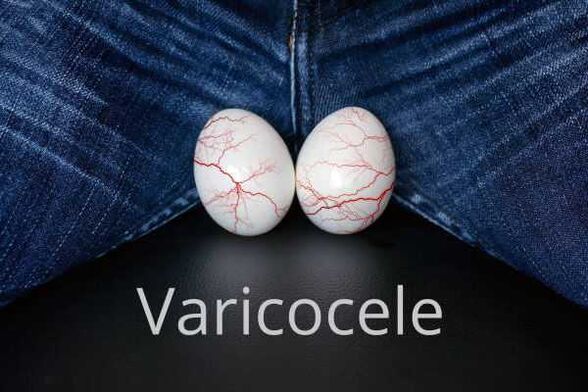 Varicocele - dilatación das veas do cordón espermático